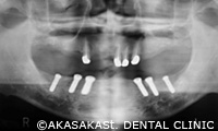  インプラントを6本埋め込む