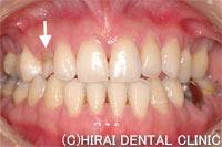 乳歯をインプラント治療した症例治療前