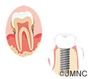 インプラント治療前に歯周病の治療が必要！