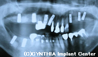 インプラント埋め入れ後のレントゲン写真