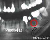 1 通常行われる診断(パノラマレントゲンの診断)