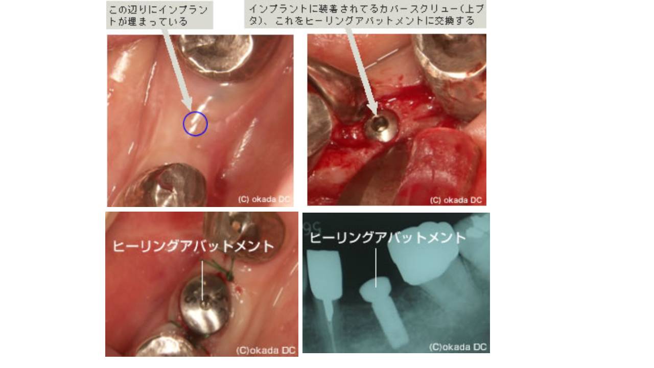 二次手術（インプラントの頭出し