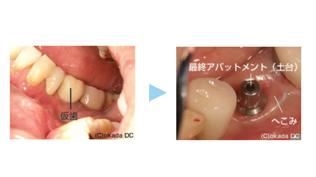 粘膜調整