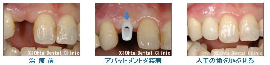 前歯を1本失った場合