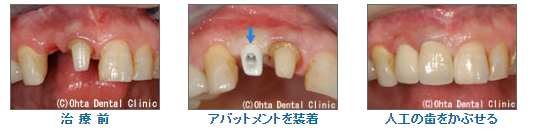 前歯の1本をインプラントでもう1本を差歯で治療した場合