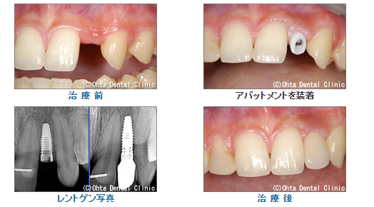 前から2番目の歯を治療した場合