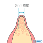 ■顎の骨の幅だけが痩せている場合