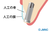 骨を増やす治療（GBR）