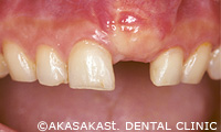 歯茎の移植手術