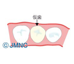 インプラントで重要な役割の仮歯