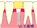 他の治療法と比較したインプラントの長所と短所