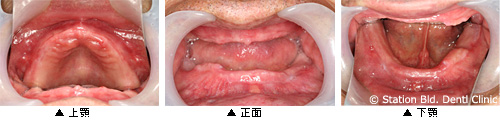 上下全ての歯がなくインプラント