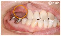 上顎右側の義歯をインプラント