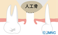 人工骨を入れて高さを確保 [イメージ]