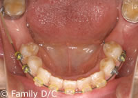矯正治療中の口腔内写真（下顎）