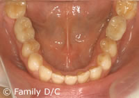 インプラント治療終了後の口腔内写真（下顎）