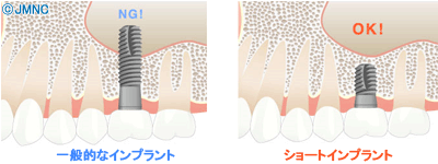 ショートインプラントとは?