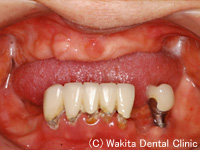 重度の歯周病で、多くの歯を失った場合