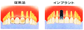 従来法：ブリッジと比較