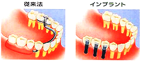 部分入れ歯と比較