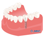 インプラント【他の歯へかかる負担】