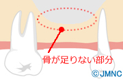 顎の骨が足りなくても骨造成は行わないインプラント治療