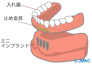 【イラスト解説】ミニインプラントの特徴とは