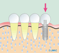 インプラント治療とは？