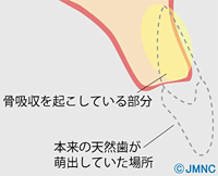 あごの骨はなぜ痩せるの インプラント治療とあごの骨の関係 インプラントネット