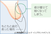 骨移植について 