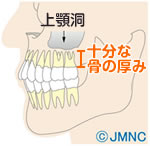 ソケットリフトが行われる場合の症状