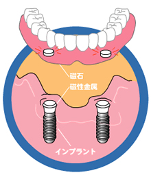 マグネット・デンチャー（磁石式入れ歯）とは？