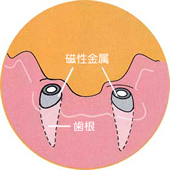 STEP 2:歯の根の治療