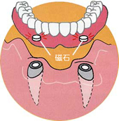STEP 3：入れ歯の製作