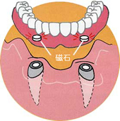 STEP 3:入れ歯の製作