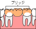 ブリッジとは ?