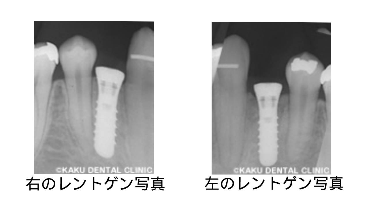 インプラントを埋め入れる