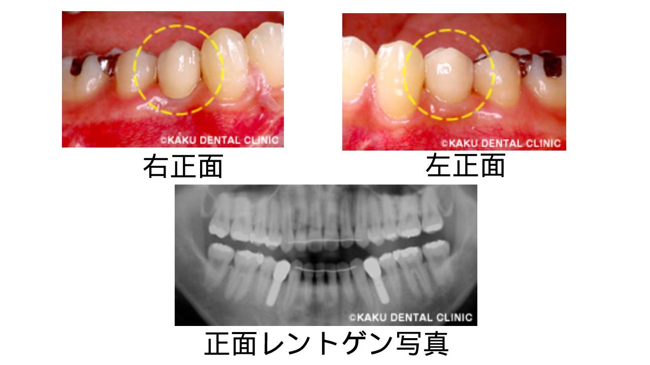 人工の歯を装着する