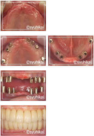上下全歯欠損（上下とも歯がない場合）