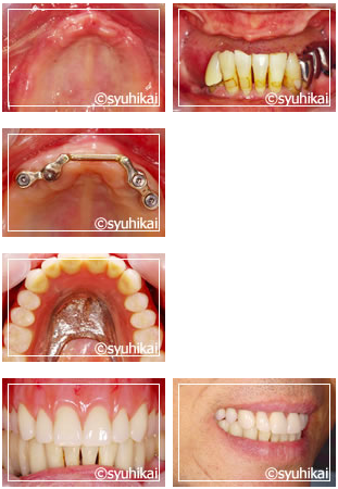 上顎無歯顎にオーバーデンチャーを装着した症例（上の歯を全て失った症例）