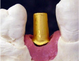 AGC（ガルバノシステム） ― 体に優しく美しい歯へ