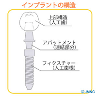 インプラントの構造について