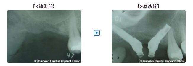 傾斜埋入インプラントの症例