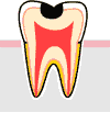 しみる虫歯の治療