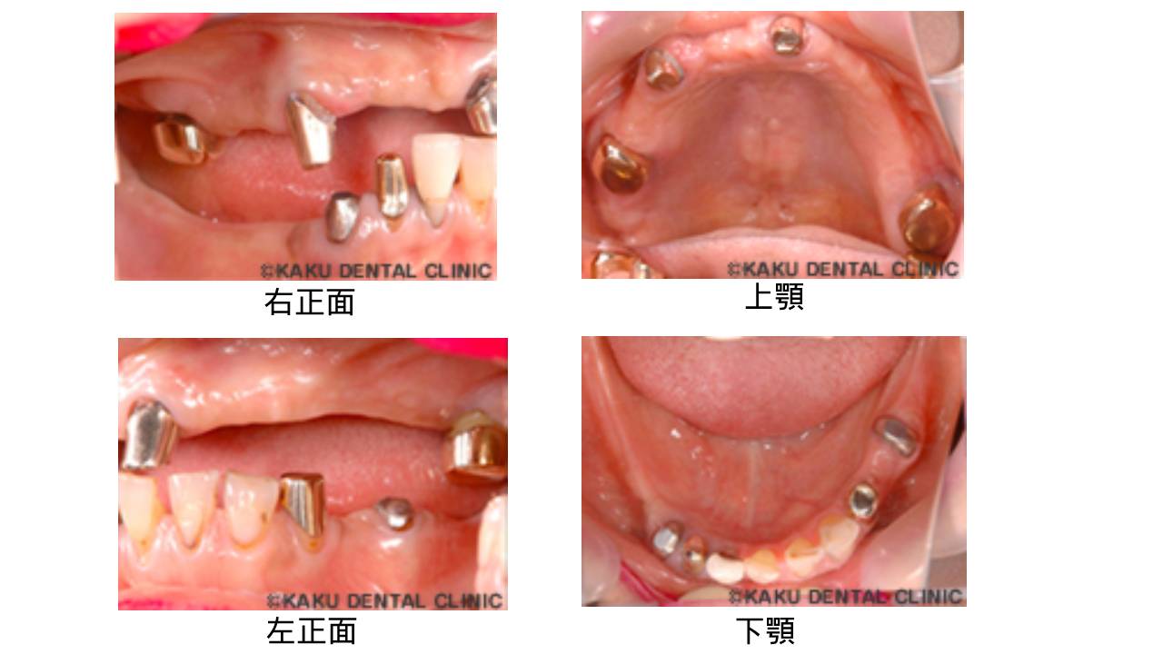 治療前の口腔内の状態