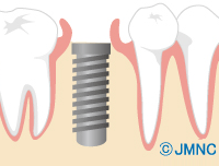 インプラントの埋入：1次手術