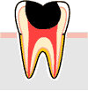 激痛が走る虫歯の治療
