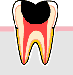 激痛の走る虫歯