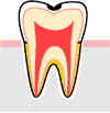 初期虫歯の治療