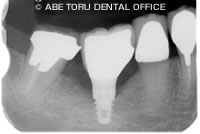 STEP2　ショートインプラントを埋め入れる